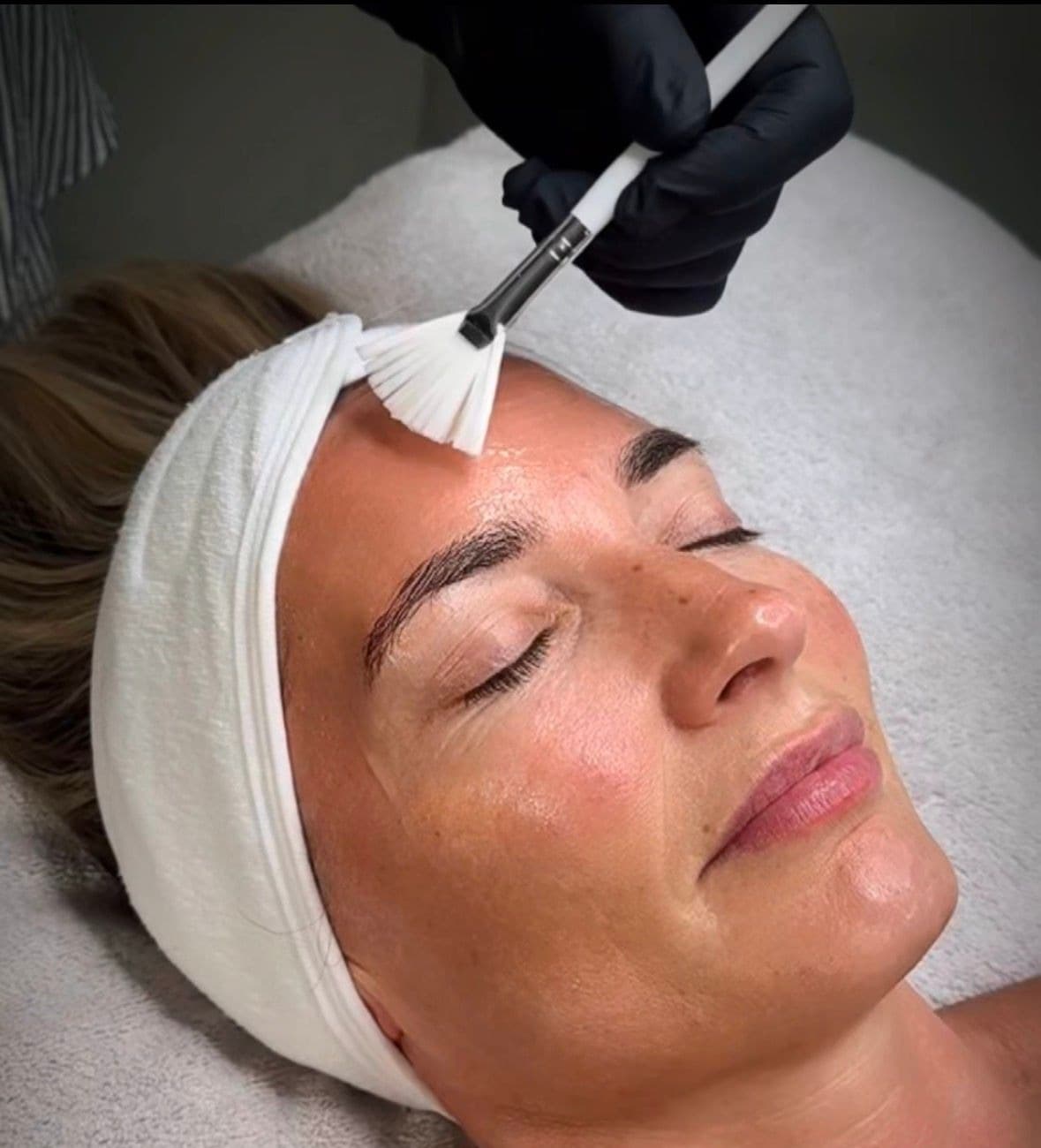 Chemical peel treatments