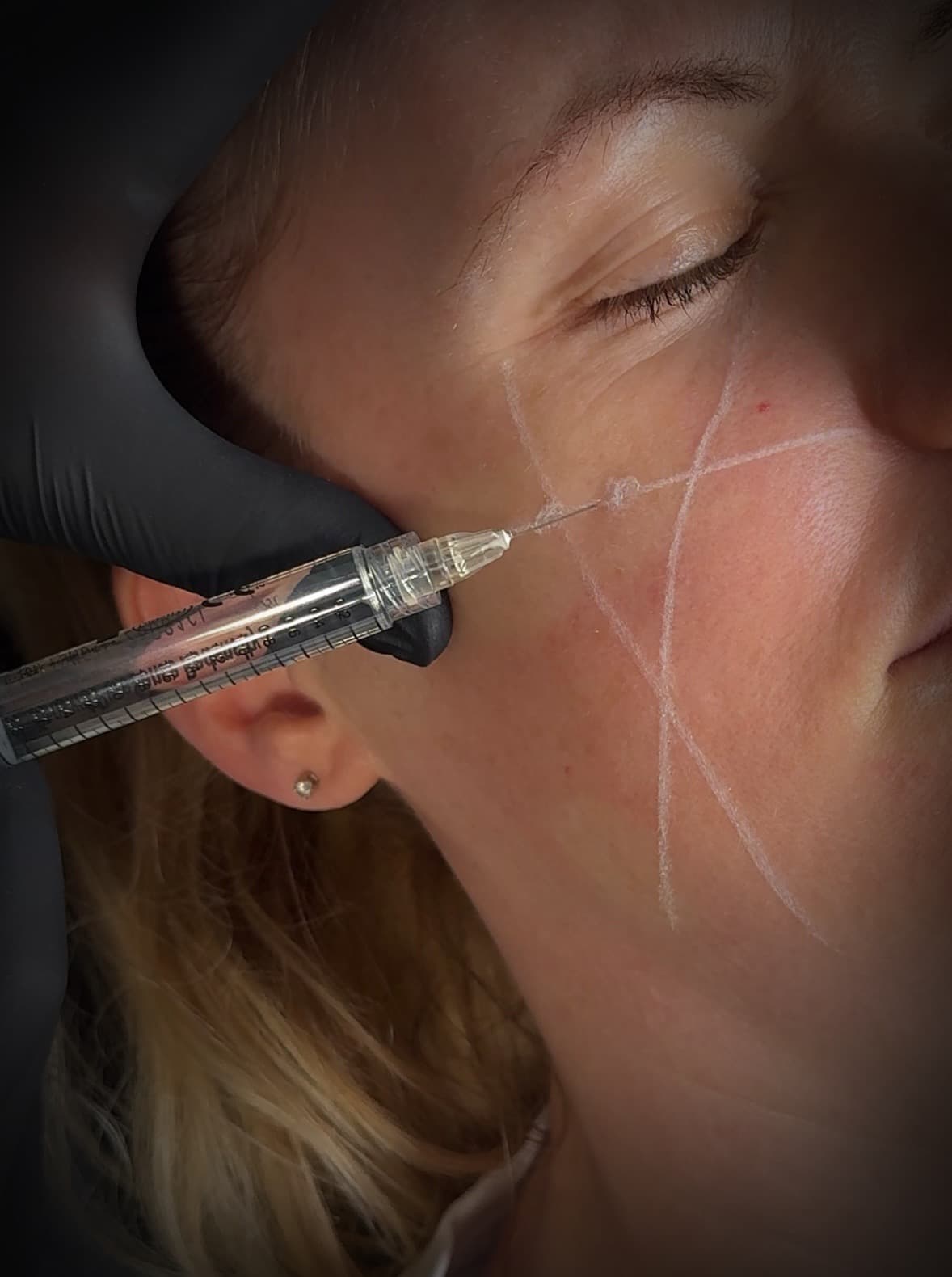 Dermal filler treatments