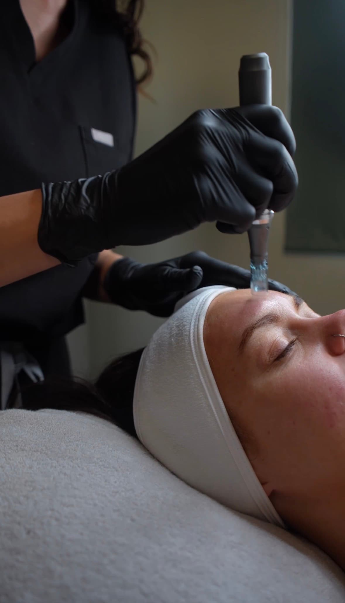 Microneedling treatments