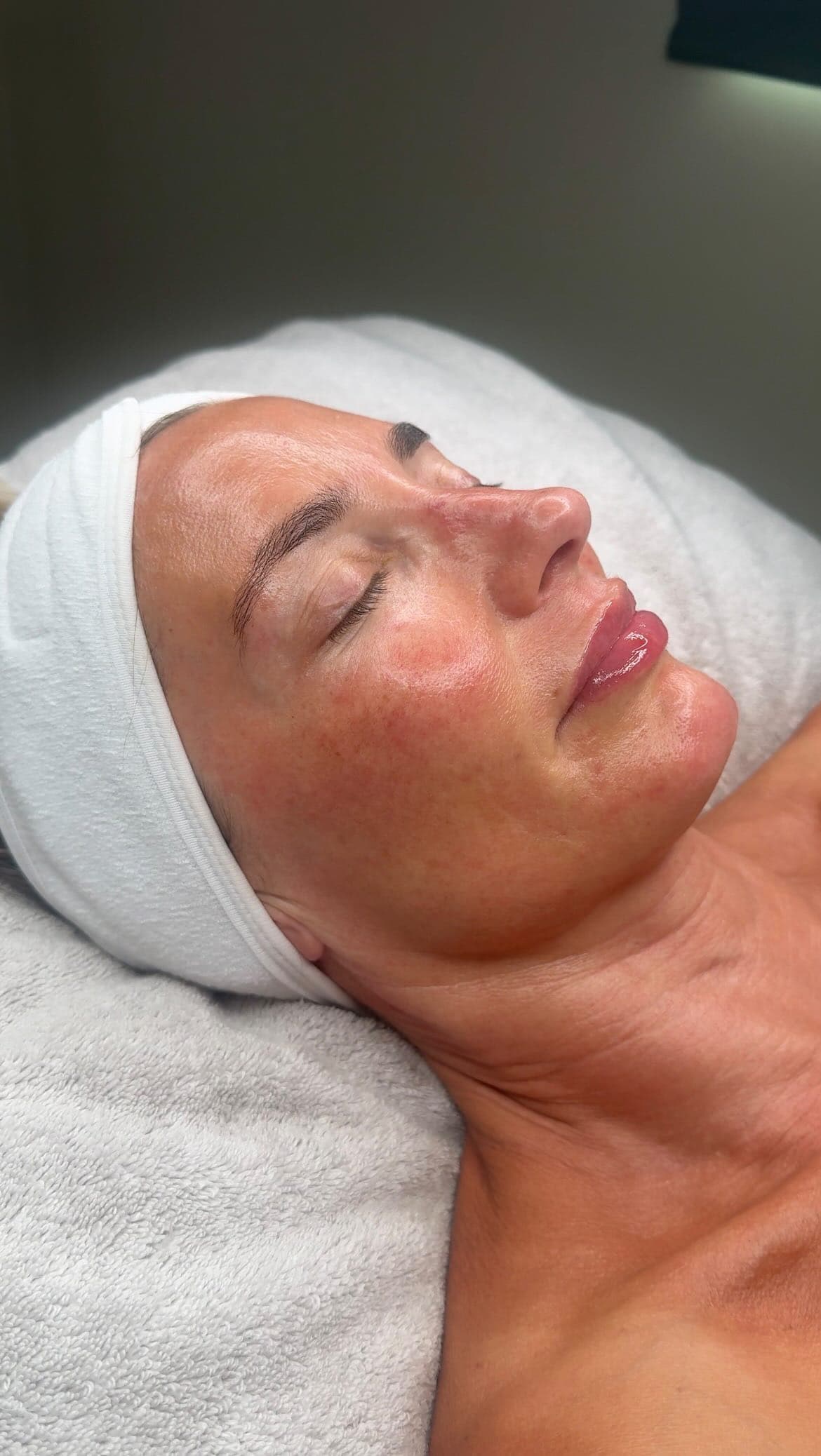 Close-up skin treatment focused on hydration and comfort